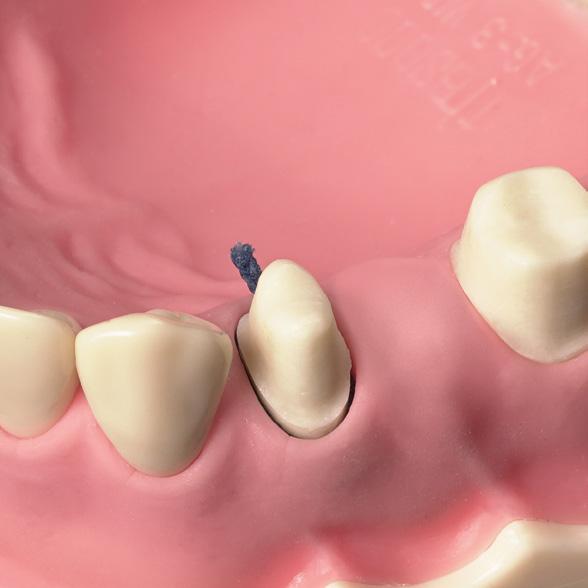 moldagem. A técnica de fio único é recomendada quando se tem um sulco raso ou apenas alguns dentes preparados. 12 Fig.