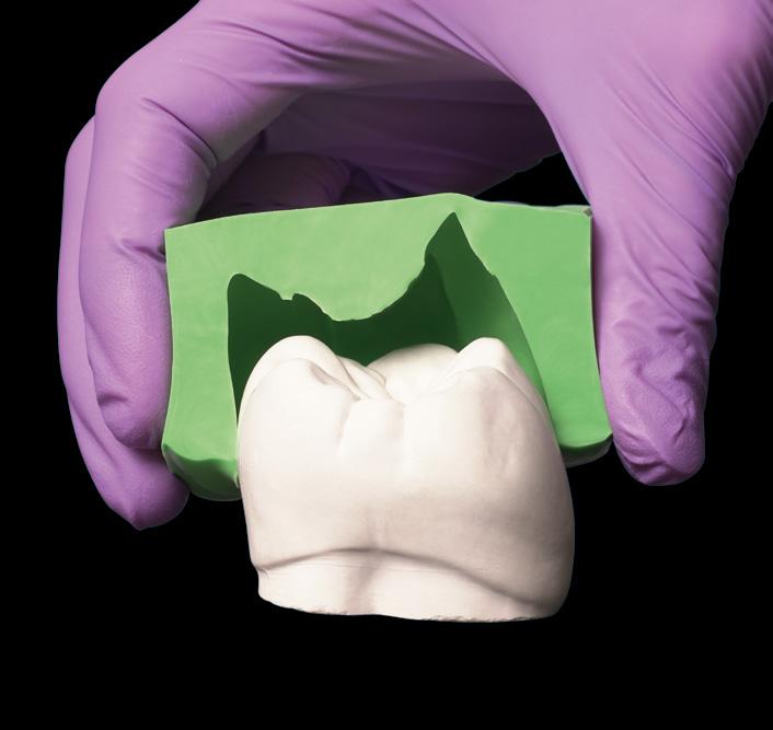 Também nas áreas de mais retenção (região posterior que sofre a mais alta compressão), deve haver distância suficiente entre a parede da moldeira e o equador dental (fig.