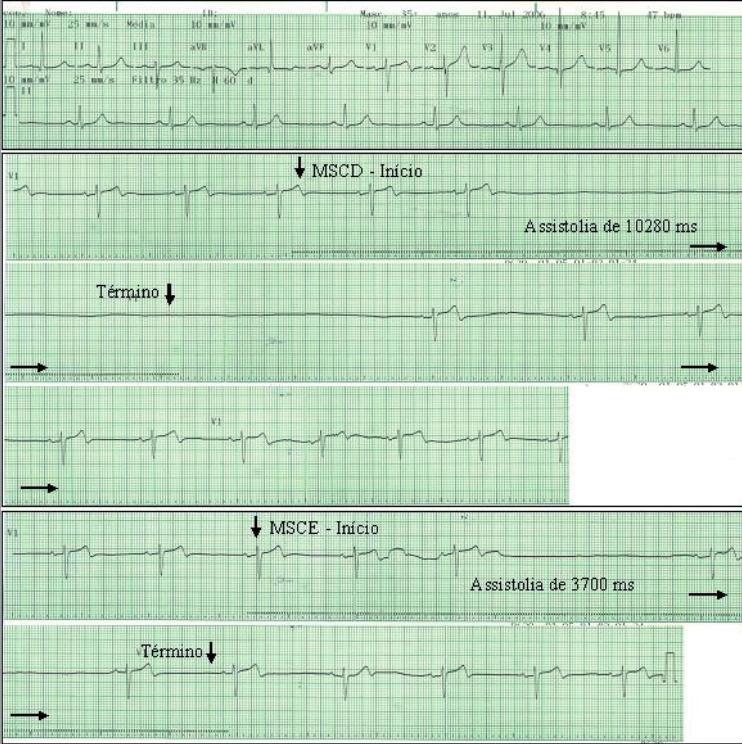 Fig. 2 - Eletrocardiograma de repouso e resultados da massagem do seio carotídeo de um homem de 57 anos, hipertenso, dislipidêmico, usuário de betabloqueador, aspirina, estatina e captopril, com