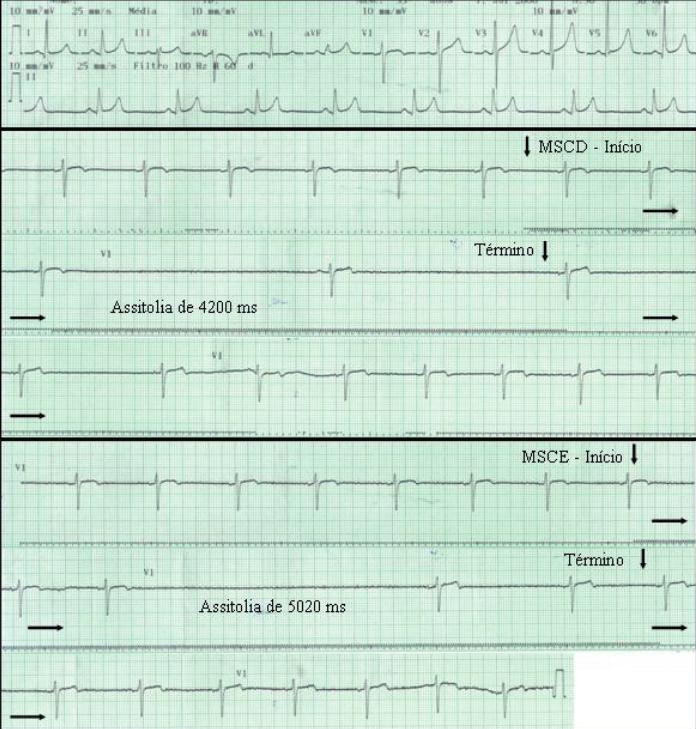 Fig. 3 - Eletrocardiograma de repouso e resultados da massagem do seio carotídeo de um homem de 67 anos, hipertenso, dislipidêmico, usuário de betabloqueador, nitrato, aspirina e estatina, com