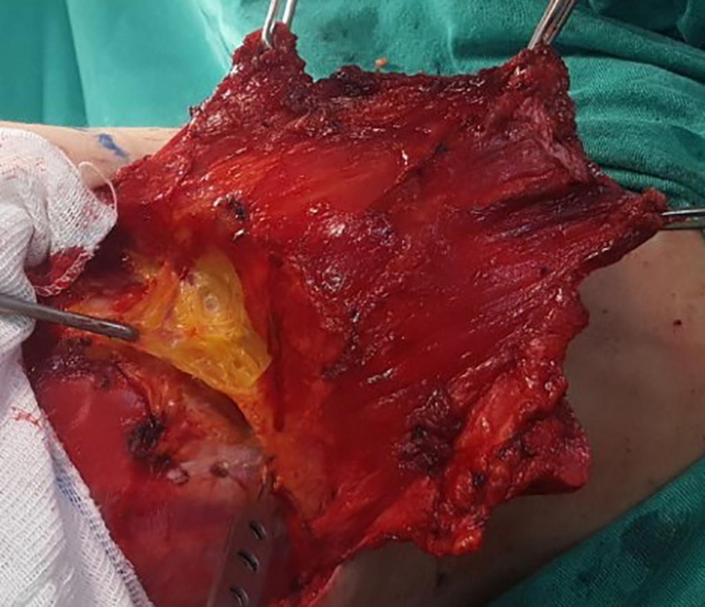 Reconstrução mamária em decúbito único lateral com retalho Nos casos de reconstrução imediata a cirurgia inicia-se com a incisão da ilha de pele, preservando um pouco da fáscia de Scarpa