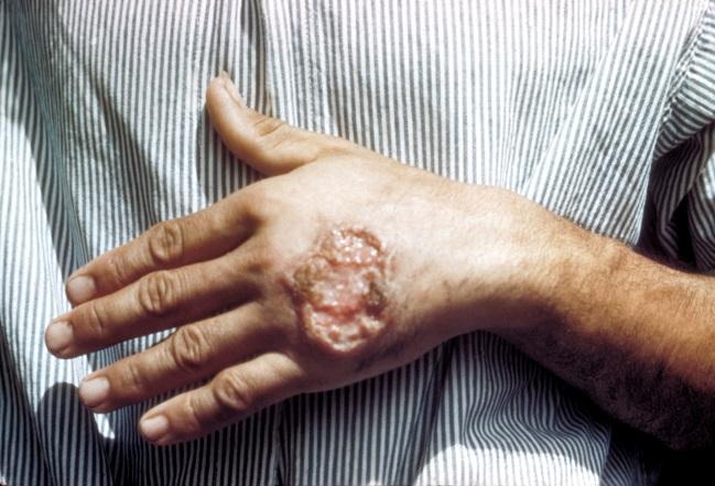 14 Figura 1 Aspecto de uma lesão de leishmaniose tegumentar. Fonte: WHO, 20