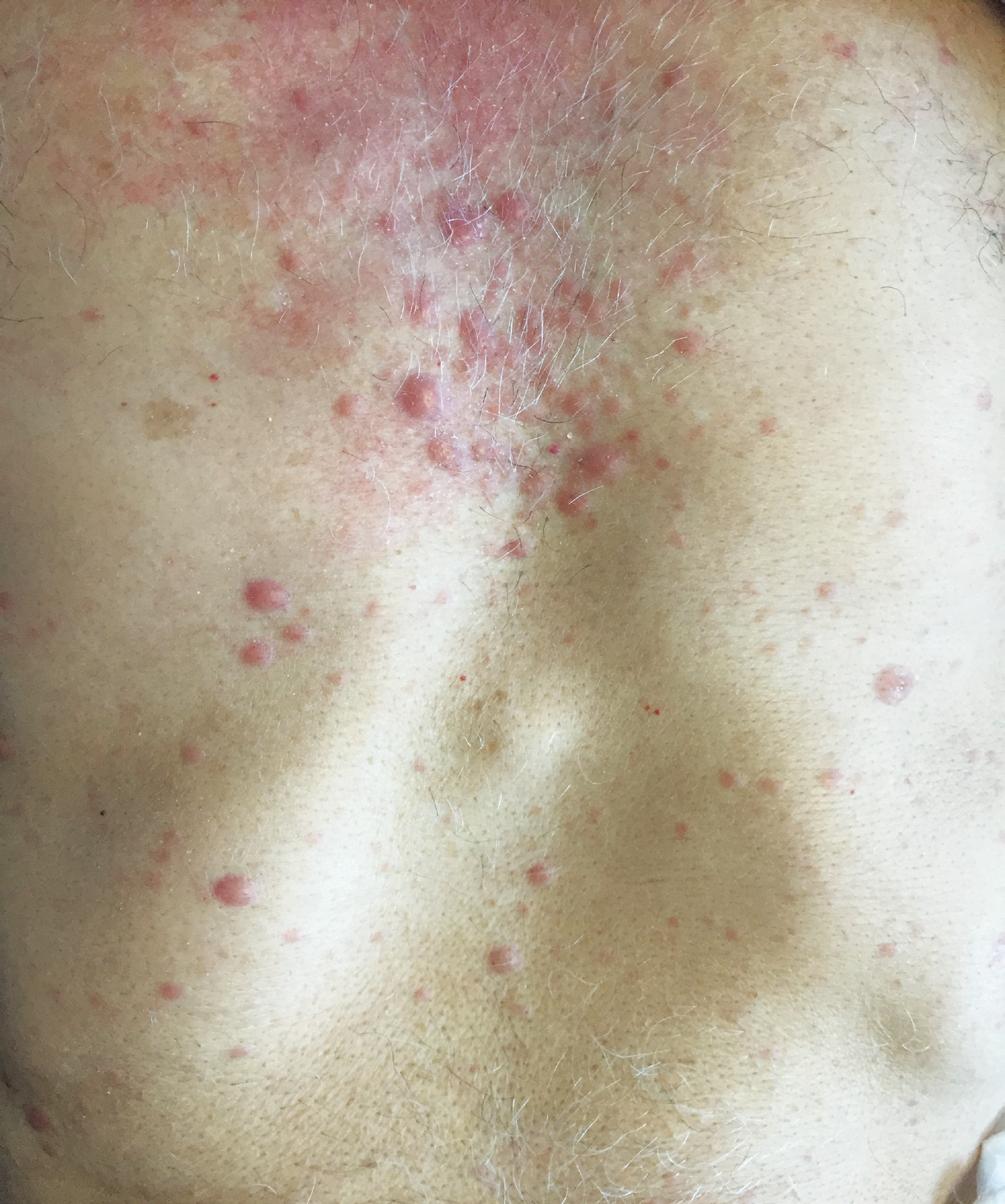 Infiltração por leucemia mieloide aguda na pele: relato de caso manifestações dermatológicas na abordagem diagnóstica de metástases de neoplasias hematológicas.
