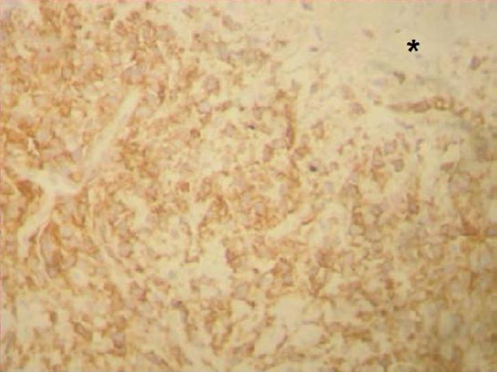 B Infiltrado de células neoplásicas na derme, poupando epiderme, e uma
