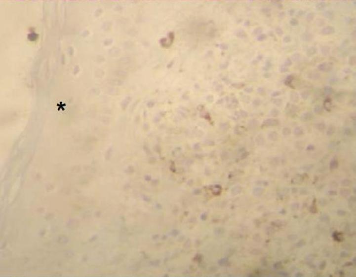 C Lençol de células neoplásicas, com escasso citoplasma, e núcleos