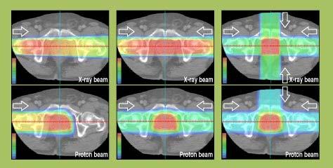 12 Figura 4 - Comparação entre o tratamento de câncer de próstata com feixes de raios-x (linha de cima) e feixes de próton.