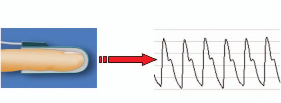 Tonometria arterial periférica. Detecta e regista as alterações pulsáteis do volume arterial periférico.