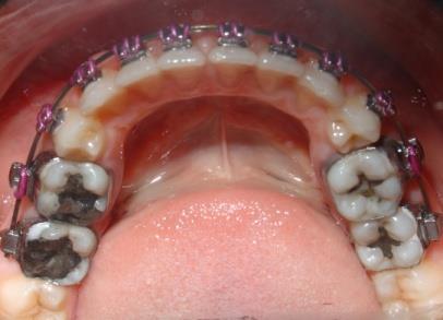 Utilizaram-se alças com o objetivo de exerce força mais próximo ao centro de resistência do dente, com mola para distalização do molar superior e