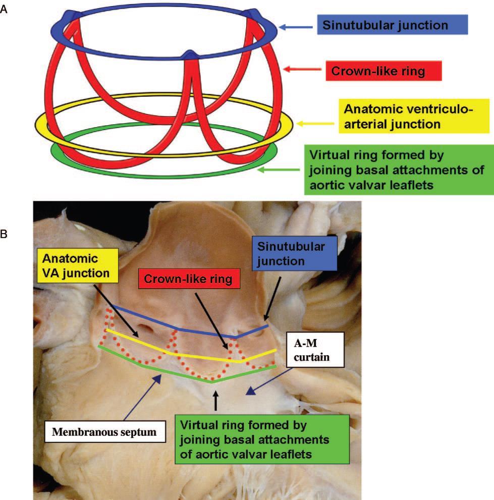 Métodos de imagem na implantação percutânea de uma prótese valvular aórtica Anatomia da válvula e raiz aórtica e características das próteses valvulares implantáveis Fazem parte da base de