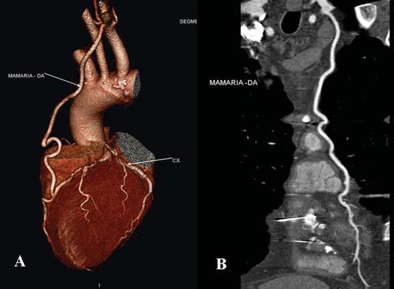 A ATID geralmente leva mais tempo para ser deslocada e anastomosada do que a esquerda e parece estar mais associada a infecção mediastinal (5) (Figuras 2, 3, 4 e 5).