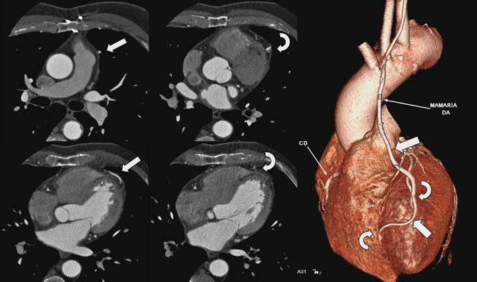 Artéria gastroepiploica A artéria gastroepiploica direita é muito útil como enxerto in situ combinado com outros enxertos, em procedimentos sem circulação extracorpórea, em que não é necessário o