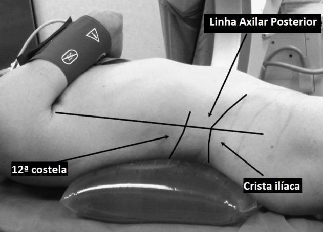 resultados obtidos num estudo realizado durante 10 anos. A técnica original consiste em deitar o doente em posição supina, mantendo o local do cálculo próximo da extremidade da mesa cirúrgica.