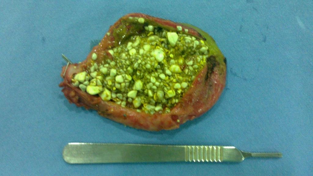 Cuidados no Tratamento Cirúrgico da Colecistite Aguda Serviço de Cirurgia