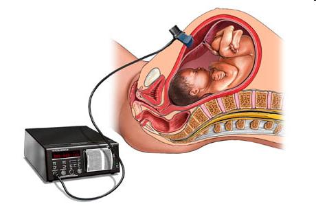 Monitorização Fetal