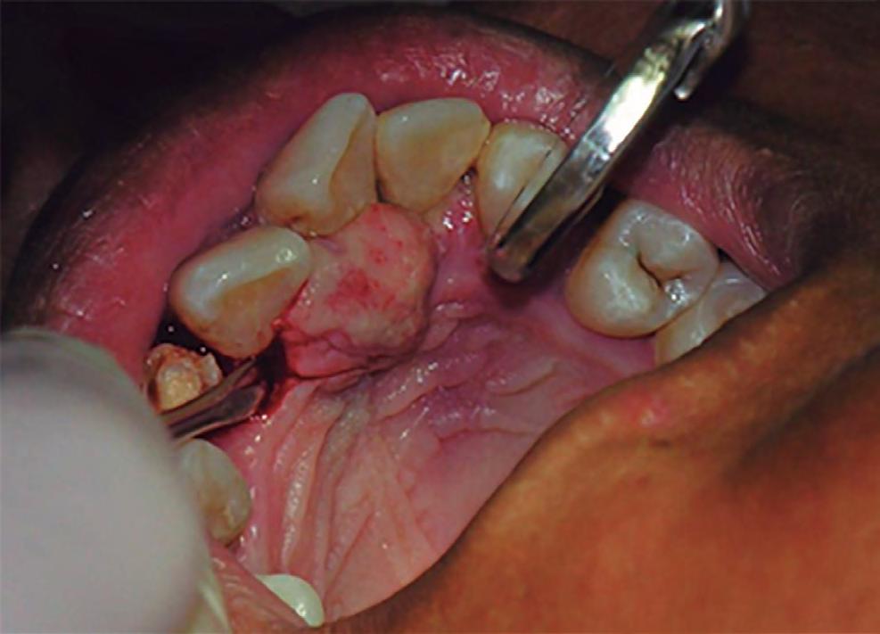 apresentar halo radiopaco ao redor da lesão. Uma característica importante radiograficamente é a reabsorção em forma de taça do osso alveolar subjacente à lesão.