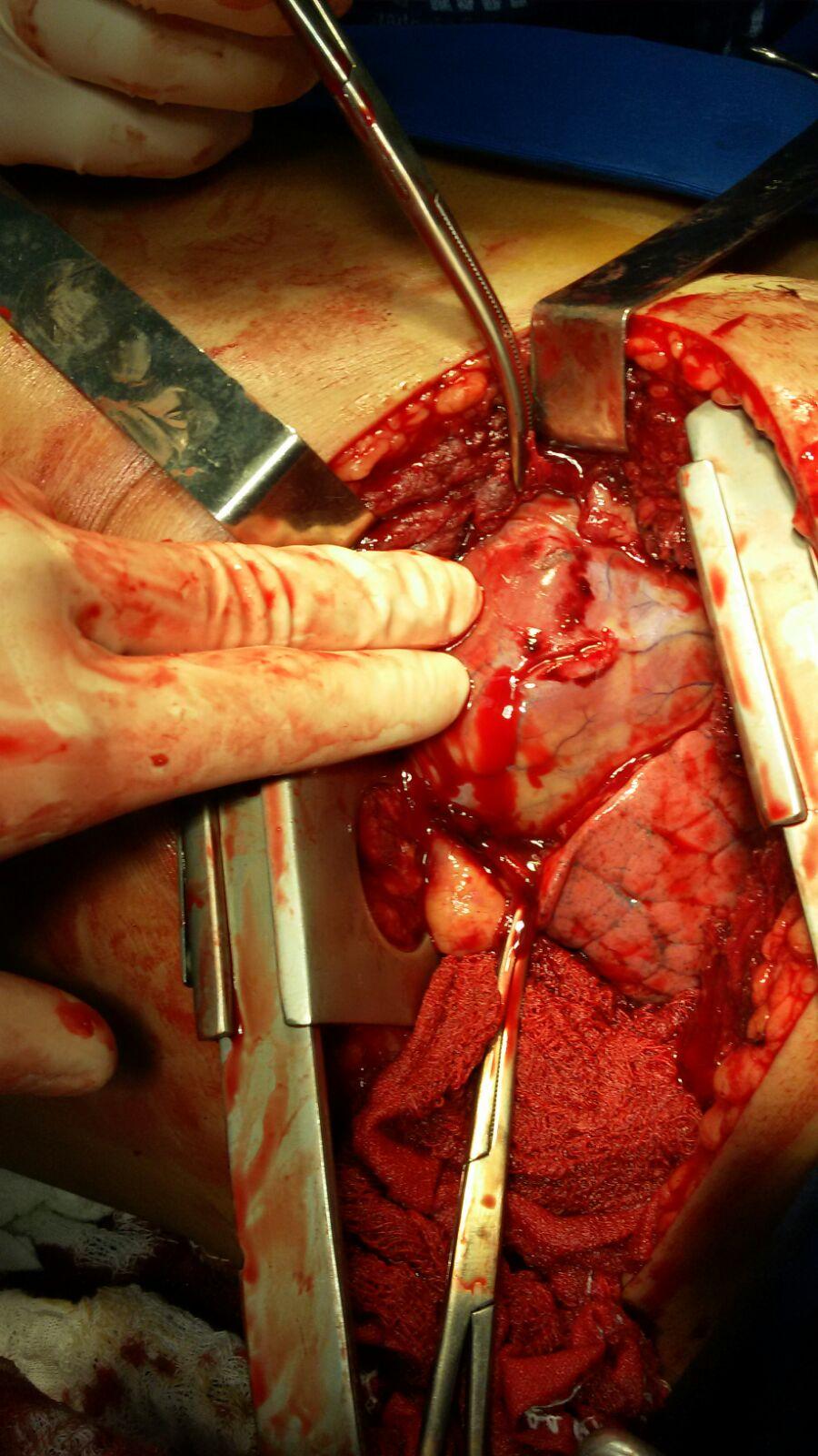 Somente 15 a 30% das lesões penetrantes necessitam de tratamento cirúrgico (toracoscopia ou toracotomia).