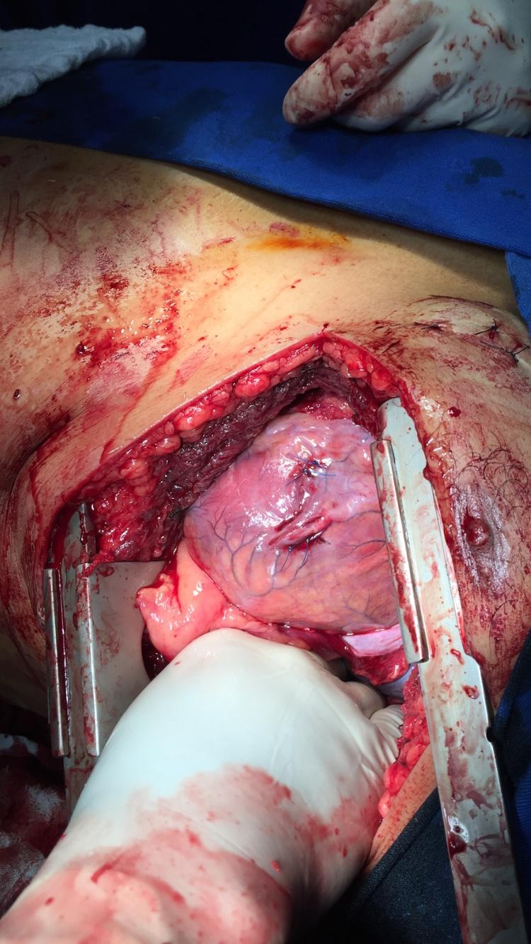 Figura 4: 2 Lesões da parede anterior do ventrículo direito pós- rafias.