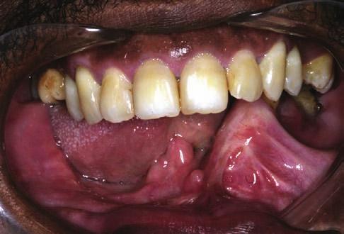 Reabilitação oral de paciente com sarcoma indiferenciado em mandíbula utilizando-se enxerto de fíbula e prótese sobre implantes INTRODUÇÃO Defeitos ósseos na mandíbula ou maxila seguidos da remoção