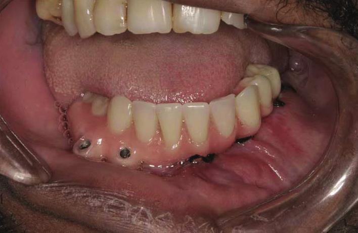 Realizou-se a instalação da prótese (Figura 11) e fez-se uma radiografi a panorâmica para controle (Figura 12).