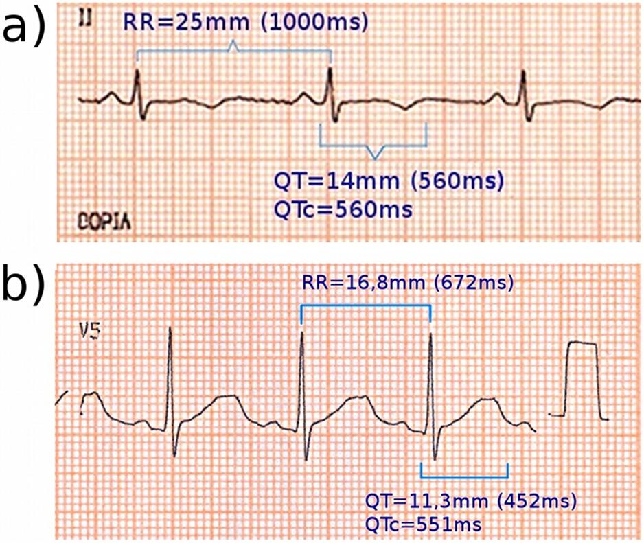 Fig. 2 - Eletrocardiogramas das probandas das famílias A (paciente A2.21) e B (paciente B2.1). O intervalo QT e o QTC encontram-se assinalados. é destacada na Figura 3.