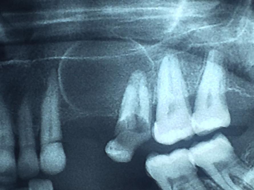 20 Figura 2 - Imagem radiográfica aproximada Fonte: Acervo do Curso de Odontologia da UNISC (2016). 3.