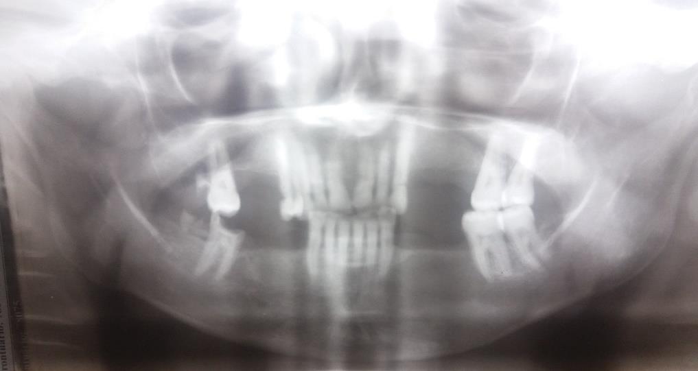 27 Figura 13 - Exame radiográfico após 5 meses da cirurgia Fonte: Acervo do Curso de Odontologia da UNISC (2016).