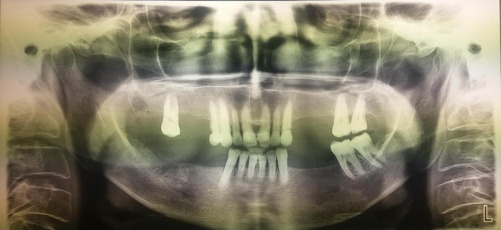 Figura 14 - Exame radiográfico após 1 ano da cirurgia Fonte: Acervo do Curso de Odontologia da UNISC (2017).