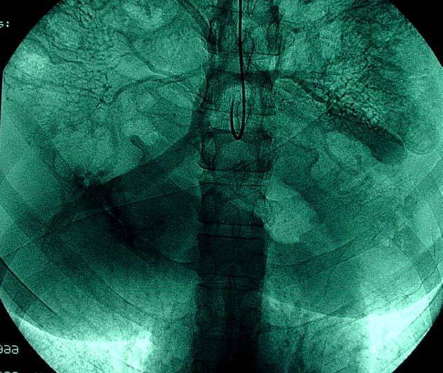 FIGURA 19. Portografia indireta após a cirurgia obtida na fase venosa da arterigrafia da mesentérica superior.