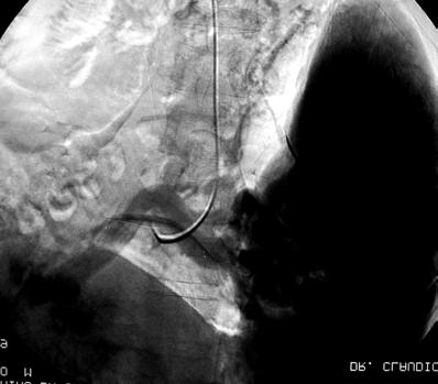Fig. 29 Pré-operatório: Portografia indireta obtida na fase venosa da arteriografia esplênica. Fig.