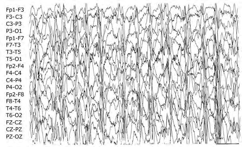 Crises epilépticas 1. Hipsarritmia com aumento da sincronização inter-hemisférica (Figura 28).