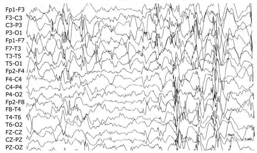 Semiologia das crises generalizadas Figura 29. Hipsarritmia assimétrica. 3.