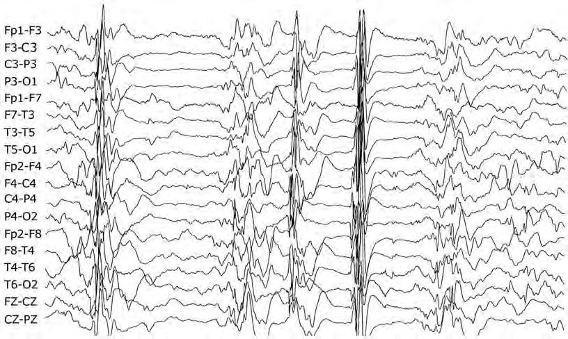 Crises epilépticas 4. Hipsarritmia com episódios de atenuação de voltagem generalizada, regional ou localizada. Neste grupo há atenuação de voltagem durante dois a dez segundos (Figura 31). Figura 31.