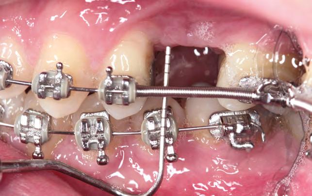 FUNDAMENTOS E SEQUÊNCIA CLÍNICA 12D 12E 12A-E Caso inicial: implante CM com cicatrizador (Sistema Neodent) instalado na região de segundo pré-molar superior direito (A,B).