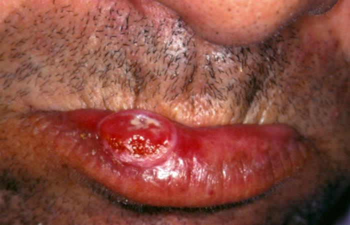 Sua célula de origem é queratinócito da camada espinhosa da epiderme. As regiões mais comuns de se aparecer são na pele e na mucosa (como boca, garganta, colo do útero, vagina e pênis).