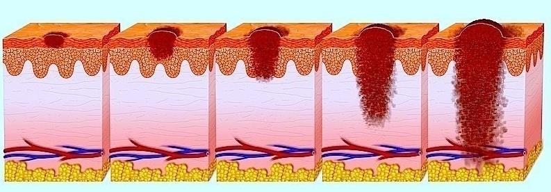 27 FIGURA 6 Níveis de Evolução do Melanoma [26]. Na fase in situ, o melanoma está presente somente na camada mais superficial da pele, a epiderme.