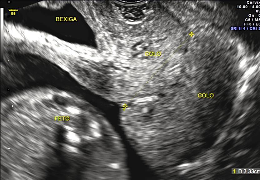Método 29 Fonte: elaborado pela pesquisadora Figura 1 - Medida do comprimento do colo uterino pela USG-TV Para a avaliação tridimensional do colo uterino utilizou-se varredura em tempo real, conforme