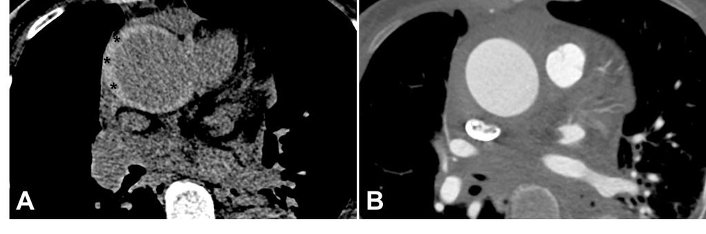 HEMATOMA INTRAMURAL Hematoma intramural: A Espessamento e hiperdensidade espontânea da parede direita da aorta ascendente [asteriscos] traduzindo o hematoma