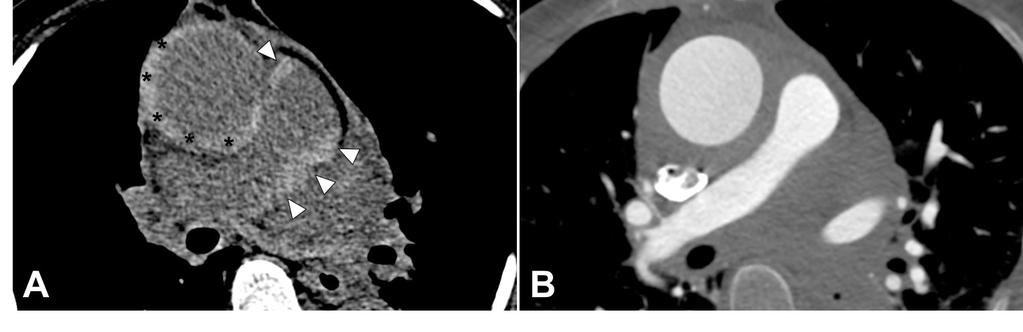 HEMATOMA INTRAMURAL Hematoma intramural com extensão para a artéria pulmonar: A Hematoma intramural da aorta ascendente [asteriscos] com espessamento e hiperdensidade espontânea da