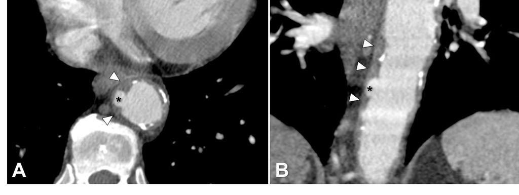 Úlcera aterosclerótica penetrante da aorta descendente: A Úlcera aterosclerótica penetrante [asterisco] na parede direita da aorta descendente, traduzida por