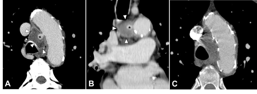Pseudoaneurisma da crossa da aorta: A e B Úlcera aterosclerótica da parede direita da crossa da aorta que progrediu para rotura com extravasamento de contraste para o