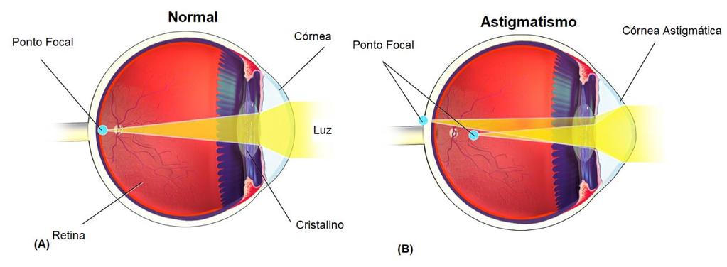 2.3. TIPOS DE ERROS REFRATIVOS raios de luz na retina. No entanto, conforme ilustrado pela figura 2.