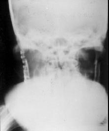 retroposicionamento mandibular (nas fraturas bilaterais).