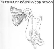 Figura 11-a. Fratura sem luxação do côndilo e sem desvio (tratamento conservador). Figura 11-b. Fratura sem luxação do côndilo e com desvio medial (tratamento conservador). Figura 12.