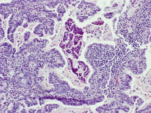 3B e Fig.3C). Os agrupamentos mencionados apresentam particularidades que estão associadas a adenocarcinoma indicando a presença de um componente glandular 1-4.