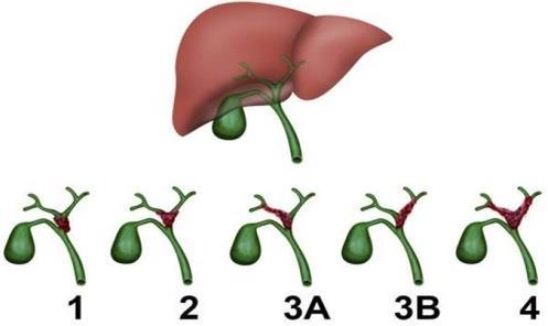 1. Introdução O colangiocarcinoma (CCA) e um ca ncer que surge da degeneração do epite lio das vias biliares, dos pequenos ductos biliares intra-hepa ticos ate o ducto biliar comum (DANI, 2011;