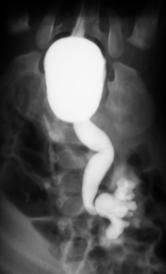 grau IV à esquerda, passivo com agravamento na fase per-miccional, associado a refluxo intra-renal. Unidades de Fig. 9 Distribuição dos resultados da % % % % Fig. 11 Distribuição das unidades de.