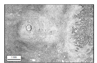 Micrometástase a 3 mm do tumor principal