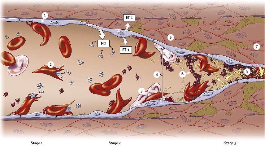 Fisiopatologia da vasoclusão na anemia falciforme 1 2 3 4 Aderência anormal ao endotélio vascular Hemólise intravascular Aderência de leucócitos Tônus vasomotor