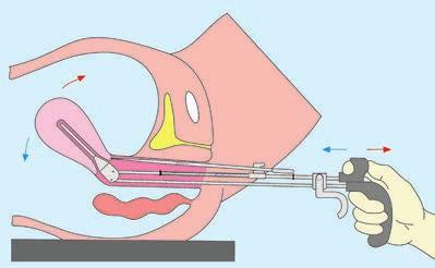 Manipulador uterino de TINTARA O manipulador uterino de TINTARA pode ser utilizado para todas as indicações em laparoscopia ginecológica, a não ser em histerectomias laparoscópicas totais.