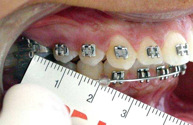 104 Material e Métodos molares inferiores também, objetivando liberar os módulos de força durante os movimentos mandibulares.